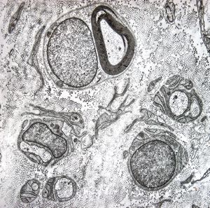  n.suralis - hypertrophic demyelinizing neuropathy